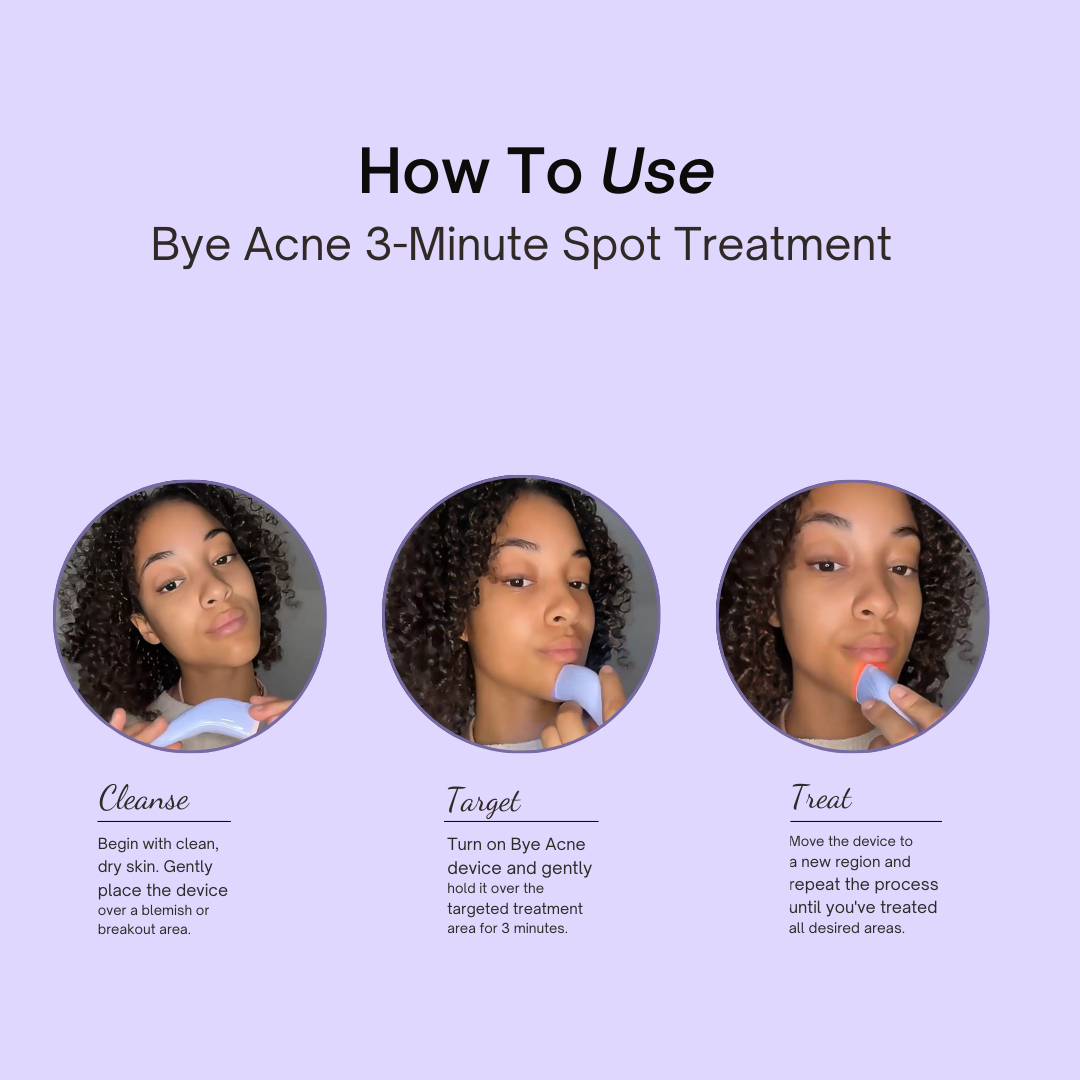 Bye Acne- Dual Light Acne Therapy