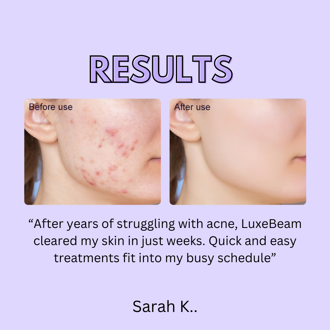 Bye Acne- Dual Light Acne Therapy